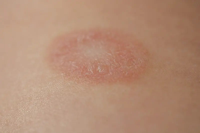 Pityriasis Alba Overview and Treatment Options